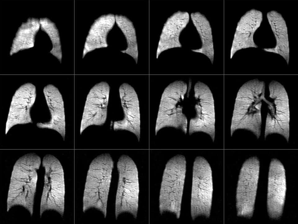 Twelve magnetic resonance images of a pair of healthy lungs, slice by slice from front to back. The lungs appear bright and evenly filled against a black background.