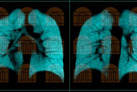 Imagine if… an inhaled contrast agent could map a broad range of relevant lung characteristics without ionizing radiation?