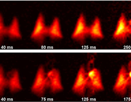 xenon dissolved in lung parenchyma and blood